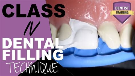 Class Iv Composite Filling Tutorial Front Tooth Filling Youtube