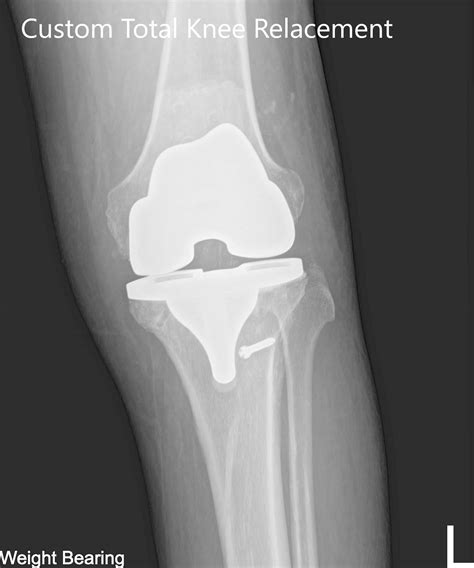 Case Study Custom Left Knee Replacement In 59 Yr Old Female