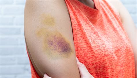 Heal Your Bruises Easily With These Remedies