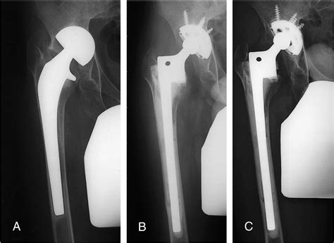 Cemented Calcar Replacement Femoral Component In Revision Hybrid Total