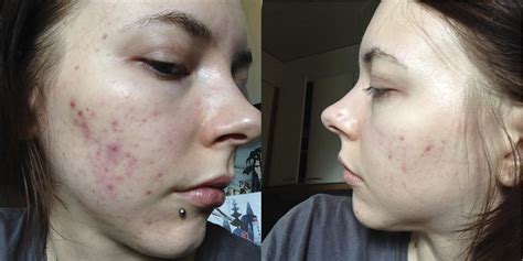 A Simple Guide To Acne Scars And How To Tackle Them At Home W Before