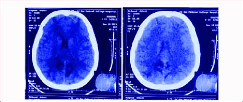 And 2 Ct Brain Showing Bilateral Diffuse Cerebral Edema Involving