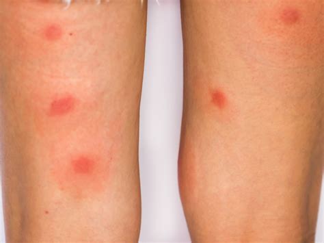 Difference Between Bed Bug Bites And Spider Bites Pest Phobia