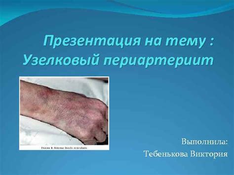 Периартериит, узелковый периартериит, что это, причины и симптомы. Презентация на тему Узелковый периартериит Выполнила ...
