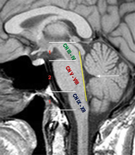 Sagittal T1 Weighted Mri Of The Brainstem Showing Normal Features Of