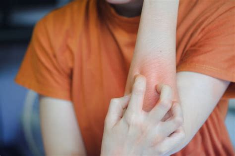 50 Infected Forearm From Mosquito Bite Stock Photos Pictures
