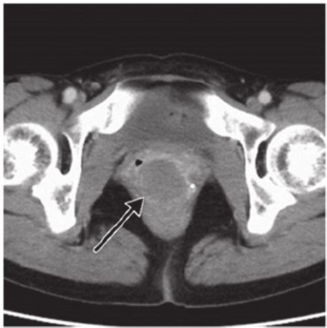 Computed Tomography Of The Pelvis Revealing A 45‐mm Tumor Black Arrow