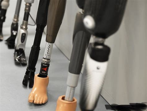 Faqs London On Hamilton Prosthetics And Orthotics