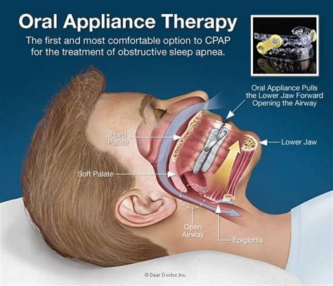 Sleep Apnea Cpap Vs Oral Appliances