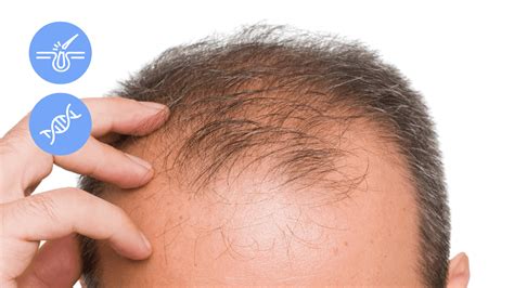 Male Pattern Baldness Identification Causestreatment And Patterns