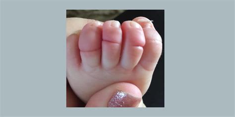 Moms Photo Of Babys Swollen Foot Sparks Awareness Of Hair Tourniquet