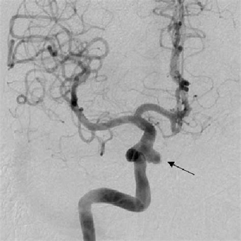 Diagnostic Cerebral Angiogram Of A Right Internal Carotid Artery