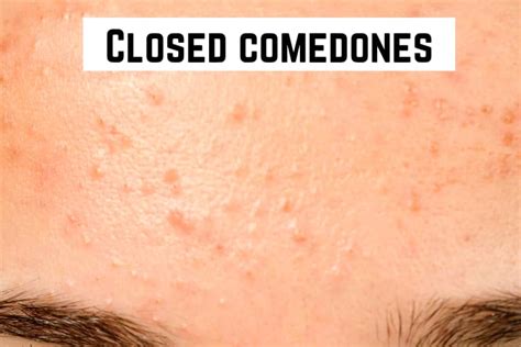 Different Types Of Acne With Pictures And Their Treatment