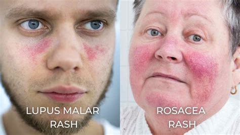 Red Alert Lupus Rash Vs Rosacea The Skin Mystery Unraveled Dermeleve®