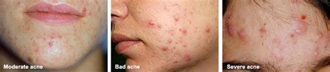 Acne And Treatment Options Frequently Asked Questions Dr Fox