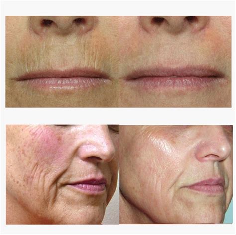 Medmatrix Co2 Fractional Laser Skin Cosmedical Beauty