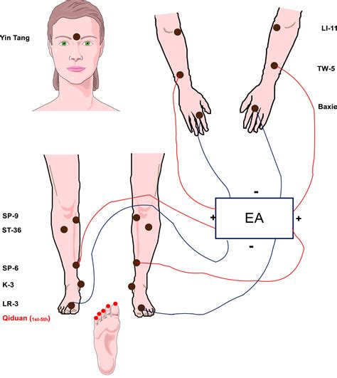 Acupuncture For Chemotherapy‐induced Peripheral Neuropathy In Breast