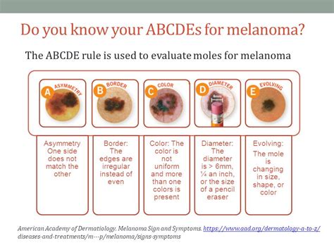 Melanoma Symptoms Abcde Doctor Heck