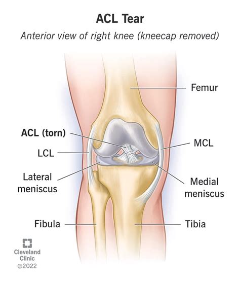 Complete Acl Tear On Mri Hot Sex Picture