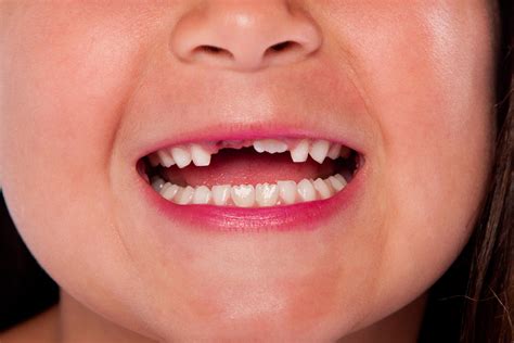 When Do Children Lose Their Baby Teeth A Definitive Guide Health