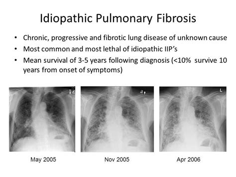 Αποτέλεσμα εικόνας για Idiopathic Pulmonary Fibrosis X Ray Findings