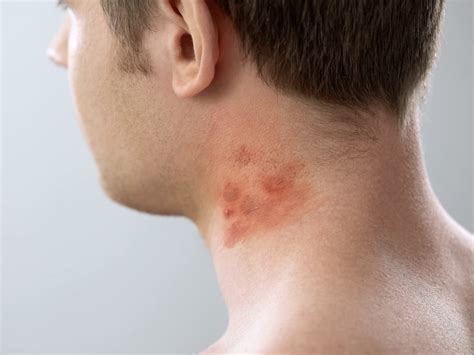Can Contact Dermatitis Look Like Acne Balmonds