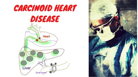 Carcinoid Heart Disease Symptoms Diagnosis And Treatment Youtube