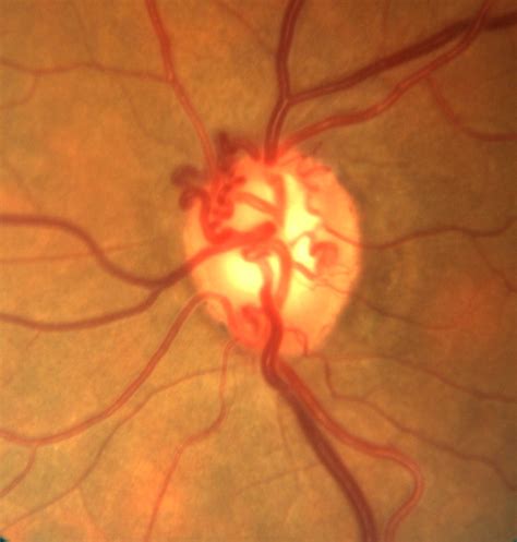 Optic Nerve Evaluation In Glaucoma California Optometric