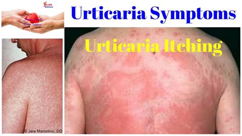 Urticaria Symptoms Urticaria Itching 😳 Youtube