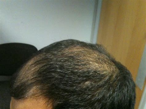 Fue For Patient With Keloid Scar Help Needed Hair Restoration
