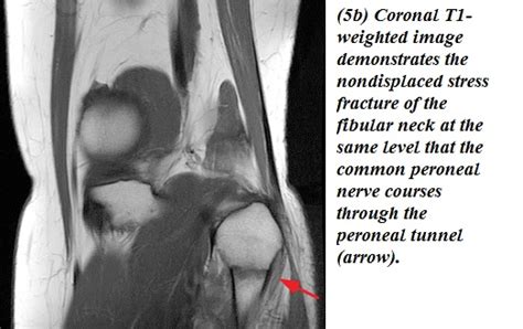 Mri Musculo Skeletal Section Common Peroneal Nerve Abnormalities