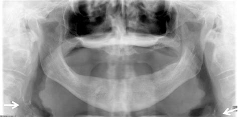 Panoramic Radiograph Of A 63 Year Old Male Patient With Heterogeneous
