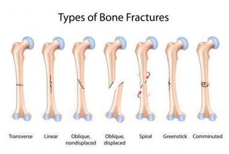 Personal Injury Compensation For Serious Bone Fractures Samples Ames