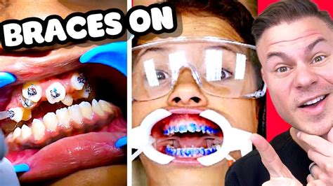 How Braces Are Put On Watch Before You Get Braces Youtube