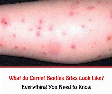 What Do Carpet Beetles Bites Look Like Getridofallthings Com
