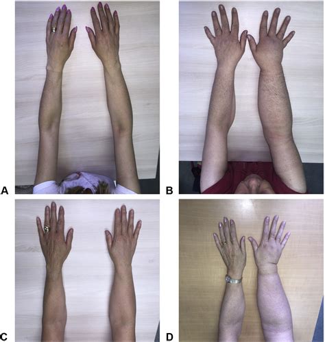 A Review Of Lymphedema For The Hand And Upper Extremity Surgeon