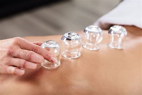 What Is Cupping Therapy The Uses Benefits And More