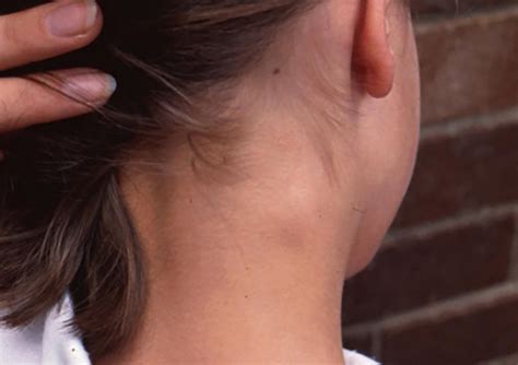 Lump On Neck Causes And Pictures Muscles Of The Neck Ear Pimple