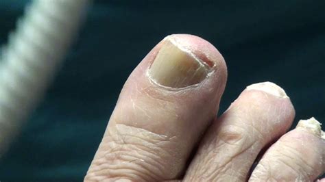 What Do Diabetic Toenails Look Like Russian And Trimming Toenails On