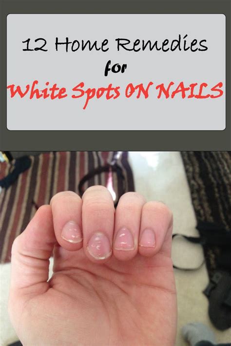 How to get rid of white dry spot on my face quora. 12 Home Remedies for white spots on nails | Nail health ...