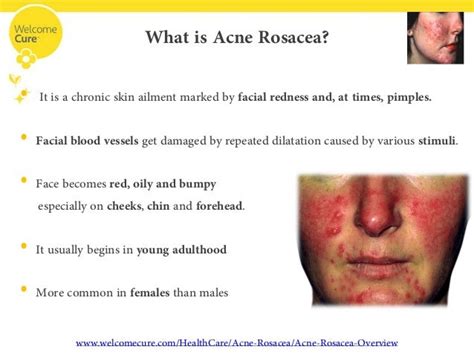Acne Rosacea The Disease Its Complications And Homeopathic Treatment