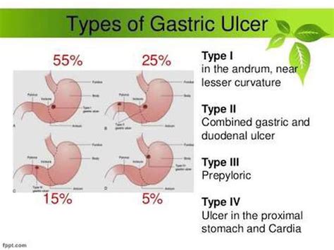 Types Of Gastric Ulcers Medizzy