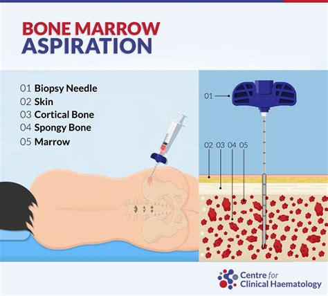 Bone Marrow Core Biopsy