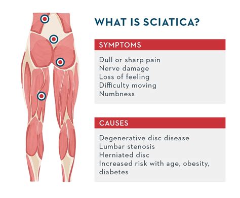 What Is Sciatica Symptoms And Causes And How To Deal With Common