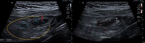 Cross‐sectional Images Demonstrating Terminal Ileitis Left B Mode