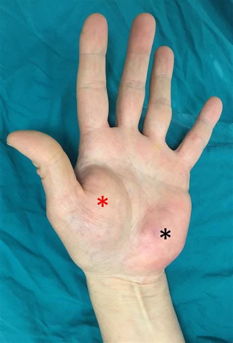Cureus Simultaneous Median And Ulnar Compression Neuropathy Secondary