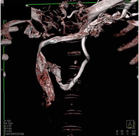 Right Aortic Arch With Aberrant Left Subclavian Artery Cardiac Case