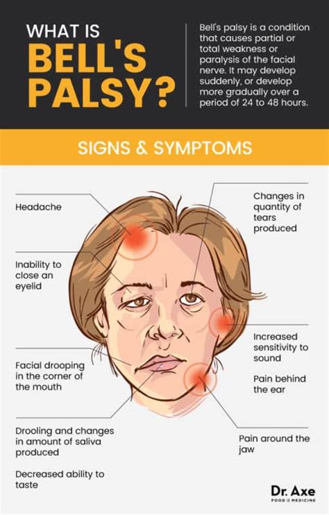 Bells Palsy 13 Natural Treatments For Bells Palsy Symptoms Dr Axe