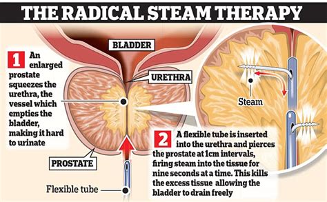 Breakthrough Treatment Cures Prostate Condition Without Surgery Hot Lifestyle News