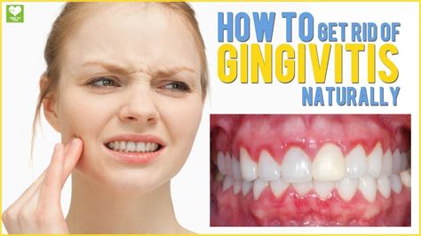 How To Get Rid Of Gingivitis Naturally Gum Disease Youtube